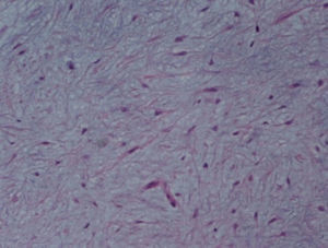 Pormenor da figura 6, mostrando células estreladas sem atipia, e estroma intercelular mixóide, sem diferenciação cartilagínea.