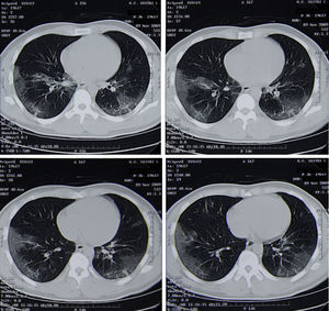 A 40-year-old man with influenza A (H1N1) virus pneumonia and severe respiratory failure (paO2/FIO2 at admission 180) who underwent non-invasive mechanical ventilation: chest computed tomography demonstrates patchy bilateral interstitial infiltrates and peripheral focal ground-glass opacities in the middle and lower lung zones.