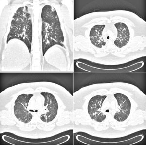 A 28-year-old man with severe obesity and sleep apnea with influenza A (H1N1) virus pneumonia and not severe respiratory failure (PaO2/FIO2 at admission 340): chest computed tomography exhibits bilateral, patchy, confluent areas of consolidation in all lung zones.