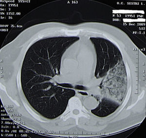 A 53-year-old man with Influenza A (H1N1) virus pneumonia and bacterial coinfection (Staphylococcus aureus) and severe respiratory failure (PaO2/FIO2 at admission 250). Chest computed tomography shows prominent interstitial opacity with ground-glass areas and air bronchogram.