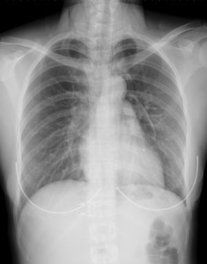Chest radiograph showed prominent subcutaneous emphysema in the neck region and air density was also observed in the paratracheal region.