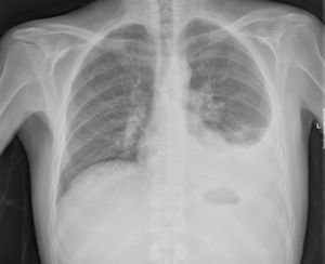 Radiografia torácica com opacidade na base esquerda sugestiva de derrame pleural.