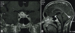 Ressonância magnética cerebral com lesão intraselar sugestiva de tuberculoma (A-corte coronal, B-corte sagital).