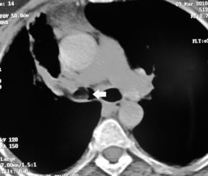CT of the chest showing an endobronchial tumor with low attenuation suggesting a fat containing lesion.