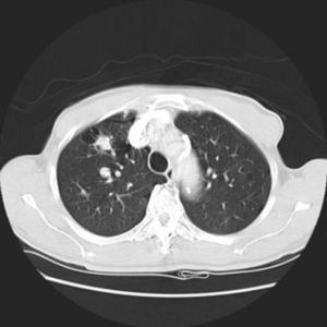 CT on presentation showing a pulmonary nodule 2cm×2cm in size.