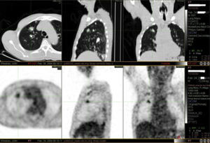 PET scan: figure showing uptake corresponding to the nodule seen on CT of the chest.