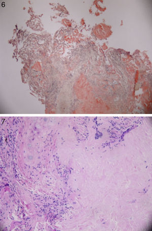 Histology showing congo red staining confirming diagnosis of amyloid. For interpretation of the references to color in this figure legend, the reader is referred to the web version of the article.)