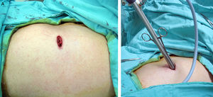 The picture shows when a lesion was localized, an instrument can be placed to hold lesion and a linear stapler can be used to resect the lesion (A). The scope can change viewing angle when needed. Without any trocar, such procedure is very easy to perform because the working space will not be limited by the lumen of rigid trocar (B).