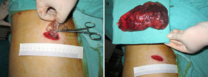 An example of single incisional thoracoscopic surgery for lobectomy of right upper lobe performed in our team. The lobe was dissected and then was placed inside a protecting bag (A). With gentle force for pulling out, the lobe can be completely removed through the small wound (B). We applied some jelly as lubricant between the lung, the bag and the wound. The pull-out procedure may take 20min.