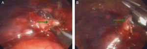 An example of hilar dissection of lobectomy of left lower lobe. In the condition of lobectomy through a single port-wound. The arterial branches can be exposed and then looped (A). After looping with a silk, a rotating linear stappler can be placed for division of the vessels (B).