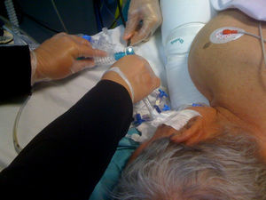 Flexible bronchoscopy in a patient during prone mechanical ventilation.