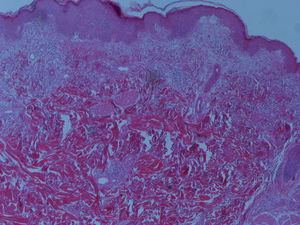 Imagem da biopsia cutânea mostrando moderado infiltrado linfohistiocitário perivascular, diagnóstico de dermatomiosite.