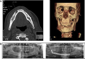 A. TC 3D da face: alteração da trabeculação óssea do corpo da mandíbula direita, com 4,2ÿ1,1cm de comprimento. B. Ortopantomografia antes e depois da cirurgia maxilo-facial: foi realizada ressecção do corpo da mandíbula direita e fixado retalho ósseo do perónio com placa reconstrutiva.