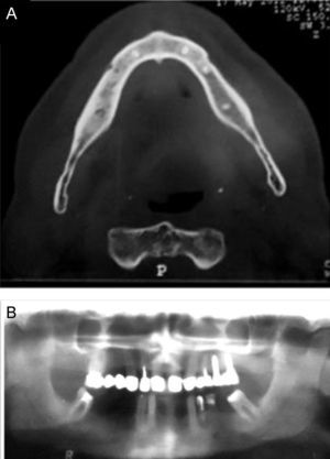 A. TC 3D: irregularidade da cortical óssea da mandíbula direita. B. Ortopantomografia confirmando as alterações na TC da face.