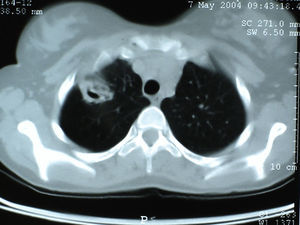 Chest CT showing an aspergilloma of anterior segment of the right upper lobe.