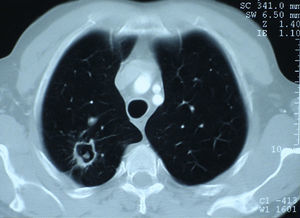 Chest computed tomography showing an aspergilloma of the posterior segment of the right upper lobe.