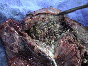 Post-operative view of the opened cavity with an intra-cavitary aspergilloma.
