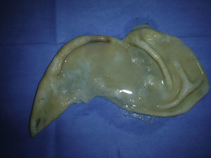 Post-operative view of an hydatid membrane.