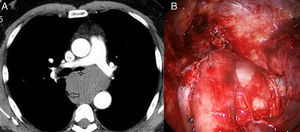 (A) Computed tomography showing a large bronchogenic cyst located in the subcarinal region narrowing left main bronchus (asterisk) and displacing esophagus (arrow). (B) Intraoperative thoracoscopy image in which we can observe the correlation with the CT image. Anterior displacement of the esophagus is (arrow) and the azygos vein is sectioned (rhombus).