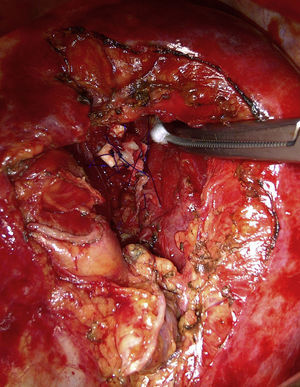 Intraoperative image, were can be observed the bronchial stump reinforced with Teflon pledgets and aortic arch mobilized.
