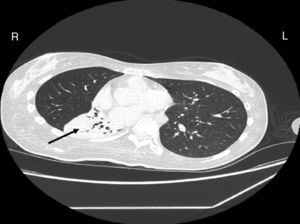 Chest CT scan at admission: atelectasis of the lower right lobe.
