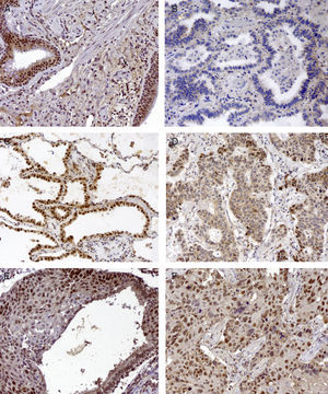 MLH1 IHC expression in one mixed type adenocarcinoma, (A) basel cell hyperplasia, (B) acinar pattern with reduced expression (−), (C) bronchioloalveolar pattern with normal expression (+++) and (D) solid pattern with reduced expression (++); MSH2 IHC expression in epidermoid carcinoma in situ and (E) corresponding epidermoid carcinoma (F) 200×.