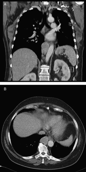 TAC com contraste torácica, imagens coronal (A) e axial (B). Linfonodos mediastínicos posteriores alargados (recesso ázigo-esofágico distal).