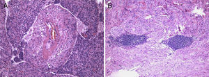 A) Células fusiformes irradiando da parede espessada de vasos e células epitelióides na periferia. Sem mitoses ou atipia detetadas. B) Vestígios de linfonodo.