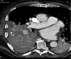 Axial CT image showing intrapulmonary ruptured BAA (with 2,4 × 2,4 cm) contained by adjacent right pulmonary parenchyma, associated with homolateral intrapulmonary hematoma and hemothorax.