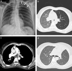 a) Chest radiograph showing a left side pneumothorax (arrows). b) Chest CT showing increased left lung volume with contralateral mediastinum shift and decreased ipsilateral lung attenuation. c) Chest CT showing a 2 cm lesion in the left main bronchus. d) Chest CT, eighteen moths after surgery, showing resolution of the mediastinum shift and similar bilateral lung attenuations.