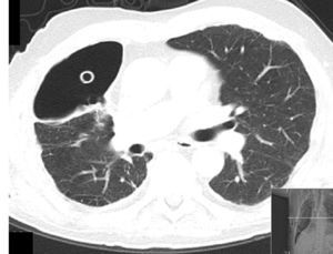 Thoracic CT scan showing pleural cavity with a chest tube inside and pleural thickening.