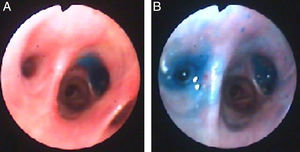 Methylene blue on segment B7 (Panel A) and B6 (Panel B) of right lower lobe after instillation through chest tube.