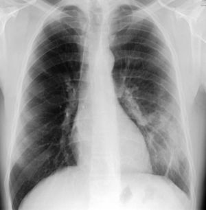 Radiografia de tórax incidência póstero-anterior (PA) demonstra irregularidade do bordo inferior da 4a à 7a costelas esquerdas («unilateral rib notching»), proeminência da vascularização pulmonar e hipotransparência do terço inferior do pulmão esquerdo.