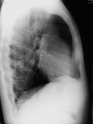 Radiografia de tórax perfil revela hipotransparência do lobo inferior desse lado como confirmado pela radiografia de perfil.