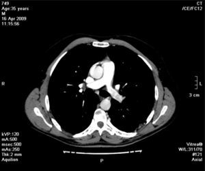 Angio-TC de tórax (pós-injeção endovenosa de contraste) no plano axial demonstra diminuição de realce do ramo esquerdo da artéria pulmonar em relação ao ramo direito da artéria homónima.