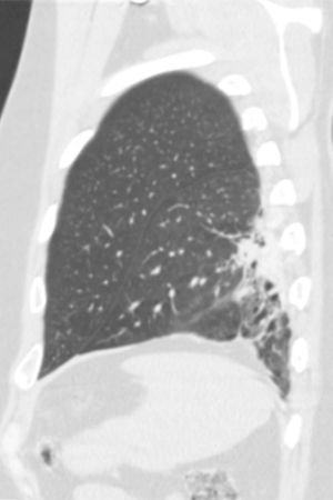 Reconstrução sagital em janela de parênquima pulmonar revela alteração do parênquima pulmonar subpleural do lobo inferior esquerdo traduzida por bronquiectasias e bronquioloectasias de tração.
