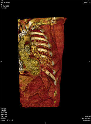 Reconstrução coronal 3D demonstra dilatação e tortuosidade das artérias intercostais.