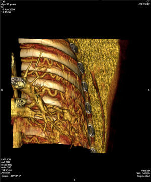 Reconstrução coronal 3D demonstra dilatação e tortuosidade das artérias intercostais e ramo segmentar da artéria pulmonar associado a novelo vascular periférico no lobo inferior esquerdo.
