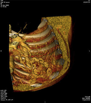 Reconstrução coronal oblíqua 3D demonstra «novelo» arterial (parcialmente extrapleural, transpleural e intraparenquimatoso) drenado via transparenquima para o ramo da artéria pulmonar homolateral.