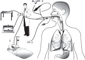 Prevention of ventilator-associated pneumonia