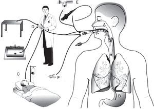 Routes of colonization/infection in mechanically ventilated patients21 A – oral and pharyngeal colonization; B – gastric colonization; C – infected patients; D – handling of respiratory equipment; E – use of respiratory devices; and F – aerosols from contaminated air.