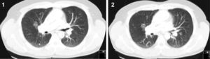 Thoracic CT scan from patient 1, November 2009, showing diffuse peribronchovascular micronodules detected in lung parenchyma.