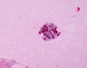 ERCC 1 expression in adenocarcinoma grade I (ERCC1 IMMUNOSTAIN 250×).