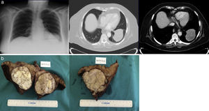 (a) Chest X-ray, contrast-enhanced thoracic computed tomography. (b) Macroscopic appearance.