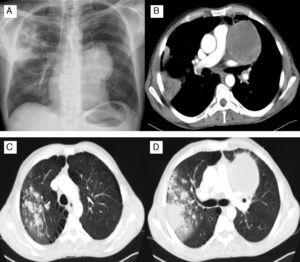 (A) Chest radiography: heterogeneous infiltration in the right upper lobe and homogeneous opacity in the left hilar region. (B)–(D) Chest Computed Tomography of the thorax: hypodense mass of 9cm with well defined margins located in the mediastinum with extension to the left upper lobe, areas of consolidation in the right upper lobe associated with micro-nodular infiltration and ground-glass opacities.