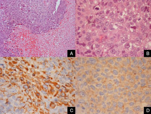 Surgical lung biopsy. A solid and poorly differentiated malignant neoplasm with extensive areas of necrosis (A – HE 200×). The tumor cells had abundant eosinophilic cytoplasm and round nuclei with evident nucleoli (B – HE 600×). Immunohistochemically, the neoplastic cells focally expressed vimentin (C – 600×) and synaptophysin (D – 600×) in the absence of epithelial and other markers (AE1/AE3, CK8/18, CK7, CK20, CK5, 34β12, EMA,TTF1, napsin-A, p63, calretinin, pS100, CD31, CD34, PLAP, beta-HCG, CD45, CD20, CD10, inhibin, C-kit, CD99, actin, desmin, GFAP, CD30, CD21, HMB45, CD56, CD23, alpha-fetoprotein, myeloperoxidase, lysozyme, WT1, ALK, HepPar-1). With those morphological and immunohistochemical characteristics in the appropriate clinical context, the diagnostic hypothesis of paraganglioma/pheochromocytoma was suggested.
