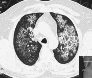 CT Scan of a patient with Pulmonary Alveolar Proteinosis. Note the thickened interlobar septa within the opacified parenchyma producing a “crazy paving” pattern.