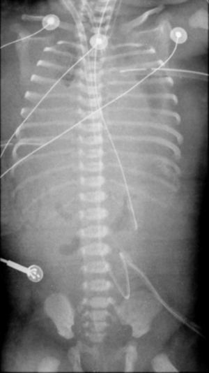 Case report 1. Chest X-ray of a 39 weeks gestational age girl on VA-ECMO: severe lung hypoplasia secondary to a bilateral congenital diaphragmatic hernia.