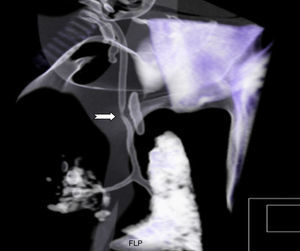 Case report 2. A chest 3D computed tomography, performed to clarify the tracheal anatomy, revealed a stenosis in the distal portion (arrow).