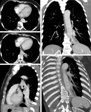 Thoracic CT with contrast: vascularized image consistent with pulmonary sequestration in the internal basal segment of the left lower lobe, extending to the posterior basal, with at least two large arteries originating from the inferior thoracic aorta.